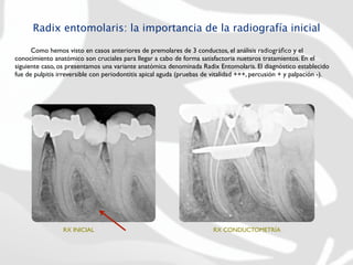 Radix entomolaris: la importancia de la radiografía inicial

	

   Como hemos visto en casos anteriores de premolares de 3 conductos, el análisis radiográﬁco y el
conocimiento anatómico son cruciales para llegar a cabo de forma satisfactoria nuetsros tratamientos. En el
siguiente caso, os presentamos una variante anatómica denominada Radix Entomolaris. El diagnóstico establecido
fue de pulpitis irreversible con periodontitis apical aguda (pruebas de vitalidad +++, percusión + y palpación -).




                 RX INICIAL                                            RX CONDUCTOMETRÍA
 