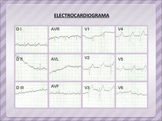 ELECTROCARDIOGRAMA D I AVR D II D III AVL AVF V1 V2 V3 V4 V5 V6 