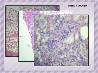 ERITEMA NODOSO  