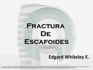 FracturaFractura
DeDe
EscafoidesEscafoides
Edgard Whiteley E.
<a rel="license" href="http://creativecommons.org/licenses/by-nc/3.0/deed.es_CL"><img alt="Licencia Creative Commons" style="border-width:0" src="http://i.creativecommons.org/l/by-nc/3.0/88x31.png" /></a><br
/>Este obra está bajo una <a rel="license" href="http://creativecommons.org/licenses/by-nc/3.0/deed.es_CL">Licencia Creative Commons Atribución-NoComercial 3.0 Unported</a>.
 