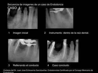 Secuencia de imagenes de un caso de Endodoncia CASO  1 : 1     Imagen inicial 2     Instrumento  dentro de la raiz dental. 3     Rellenando el conducto 4     Caso concluido Cortesia del Dr. Juan Jose Echeverria Garcidueñas. Endodoncista Certificado por el Consejo Mexicano de Endodoncia. 