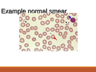 Example normal smearExample normal smear
From UpToDate,
http://www.uptodate.com/online/content/image.do;jsessionid=B
8AAB868DBB1B8B6463E3749C695F04E.1004?
imageKey=HEME%2F9057
 