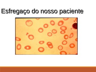 Esfregaço do nosso pacienteEsfregaço do nosso paciente
. 26 anos, sexo feminino, apresentando a avaliação
após a tentativa de doar sangue e estar foi dito que ela
estava anêmica
 