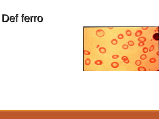Def ferroDef ferro
Progressão da
mudança:
hipocromia,
microcitose,
anisocitose (RDW
aumentado)
 