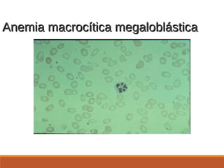 Anemia macrocítica megaloblásticaAnemia macrocítica megaloblástica
 