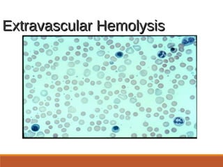 Extravascular HemolysisExtravascular Hemolysis
 