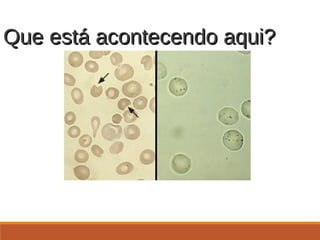 Que está acontecendo aqui?Que está acontecendo aqui?
http://www.uptodate.com/online/content/image.do;jsessionid=49B7B6DD5EECE1FD7800FA
ECB4D78805.1102?imageKey=HEME%2F8853
 