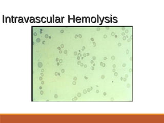 Intravascular HemolysisIntravascular Hemolysis
 
