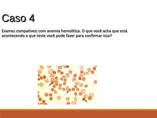 Caso 4Caso 4
Exames compatíveis com anemia hemolítica. O que você acha que estáExames compatíveis com anemia hemolítica. O que você acha que está
acontecendo e que teste você pode fazer para confirmar isso?acontecendo e que teste você pode fazer para confirmar isso?
From UpToDate,
http://www.uptodate.com/online/c
ontent/image.do;jsessionid=B8A
AB868DBB1B8B6463E3749C69
5F04E.1004?imageKey=HEME
%2F9278
 
