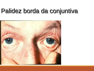 Palidez borda da conjuntivaPalidez borda da conjuntiva
 