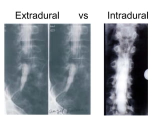 Casos cerrado resuelto: Quiste aracnoideo intradural extramedular | PPT