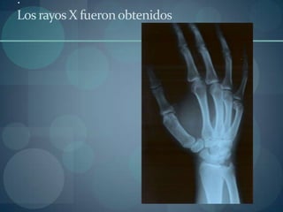 . Los rayos X fueron obtenidos