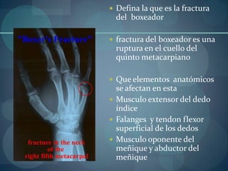 Defina la que es la fractura del  boxeadorfractura del boxeador es una ruptura en el cuello del quinto metacarpianoQue elementos  anatómicos se afectan en estaMusculo extensor del dedo índiceFalanges  y tendonflexor superficial de los dedosMusculo oponente del meñique y abductor del meñique