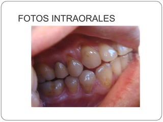 FOTOS INTRAORALES