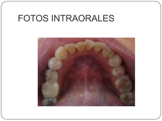 FOTOS INTRAORALES