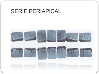 SERIE PERIAPICAL