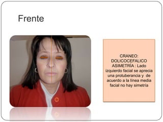 FrenteCRANEO: DOLICOCEFALICOASIMETRÍA : Lado izquierdo facial se aprecia una protuberancia y  de acuerdo a la línea media facial no hay simetría