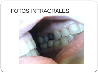FOTOS INTRAORALES