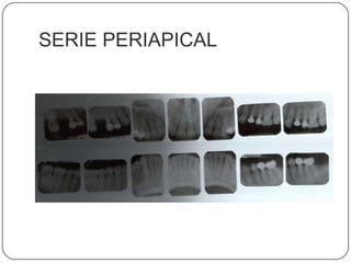 SERIE PERIAPICAL