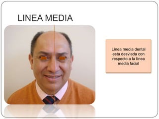 LINEA MEDIA Línea media dental esta desviada con respecto a la línea media facial 