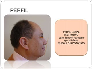 PERFILPERFIL LABIAL :RETRUSIVOLabio superior retrasado que el inferiorMUSCULO:HIPOTONICO