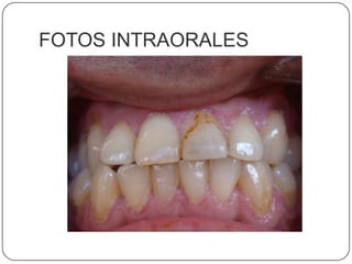 FOTOS INTRAORALES