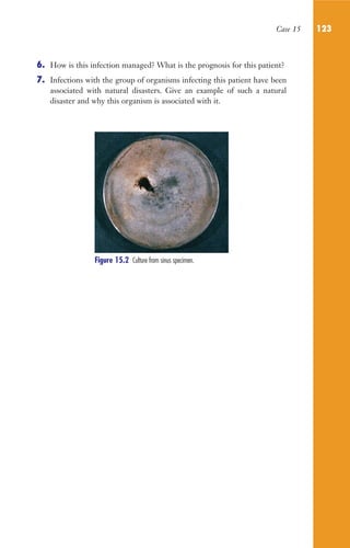 Case 15 123
6. How is this infection managed? What is the prognosis for this patient?
7. Infections with the group of organisms infecting this patient have been
associated with natural disasters. Give an example of such a natural
disaster and why this organism is associated with it.
Figure 15.2 Culture from sinus specimen.
Gilligan_Sec2_063-156.indd 123 7/24/14 11:43 AM
 