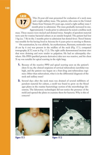 132
This 26-year-old man presented for evaluation of a neck mass
and a right axillary mass. The patient, who came to the United
States from Vietnam 6½ years ago, noted a right axillary mass 1
month prior to admission. The mass gradually increased in size.
Approximately 3 weeks prior to admission he noted a midline neck
mass. These masses were incised and drained twice. Samples of purulent material
were sent for routine bacterial culture at an outside hospital. The patient had lost
3 kg (ca. 7 lb) in the 2 months prior to admission but denied fever. Travel history
was notable for his having lived in Arizona for 6 years prior to moving to Boston.
On examination, he was afebrile. An erythematous, fluctuant, nontender mass
(8 cm by 6 cm) was present in the midline of the neck (Fig. 17.1; computed
tomography [CT] scan in Fig. 17.2). The right axilla demonstrated incision sites
that were draining and were tender to palpation. He had no adenopathy else-
where. His PPD (purified protein derivative) skin test was reactive, and his chest
X ray was notable for apical scarring in the right lung.
1. Because of the reactive PPD and apical scarring seen on the patient’s
chest X ray, the clinical suspicion of cervical tuberculosis (scrofula) was
high, and the patient was begun on a four-drug anti-tuberculous regi-
men. Other than tuberculosis, what is in the differential diagnosis of the
neck and axillary mass?
2. Several days after the neck mass was drained of several milliliters of
purulent material for culture, a mold was found to grow on the blood
agar plates in the routine bacteriology section of the microbiology lab-
oratory. The laboratory technologist did not notice the presence of the
mold and opened the plates to examine them for bacteria. Why is this of
concern?
This 26-year-old man presented for evaluation of a neck mass
States from Vietnam 6½ years ago, noted a right axillary mass 1
month prior to admission. The mass gradually increased in size.
Approximately 3 weeks prior to admission he noted a midline neck
CASE
17
Figure 17.1 Figure 17.2
Gilligan_Sec2_063-156.indd 132 7/24/14 11:43 AM
 