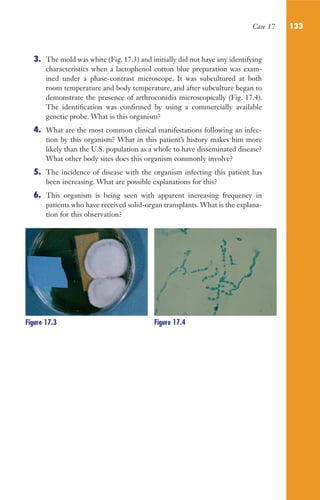 Case 17 133
3. The mold was white (Fig. 17.3) and initially did not have any identifying
characteristics when a lactophenol cotton blue preparation was exam-
ined under a phase-contrast microscope. It was subcultured at both
room temperature and body temperature, and after subculture began to
demonstrate the presence of arthroconidia microscopically (Fig. 17.4).
The identification was confirmed by using a commercially available
genetic probe. What is this organism?
4. What are the most common clinical manifestations following an infec-
tion by this organism? What in this patient’s history makes him more
likely than the U.S. population as a whole to have disseminated disease?
What other body sites does this organism commonly involve?
5. The incidence of disease with the organism infecting this patient has
been increasing. What are possible explanations for this?
6. This organism is being seen with apparent increasing frequency in
patients who have received solid-organ transplants. What is the explana-
tion for this observation?
Figure 17.3 Figure 17.4
Gilligan_Sec2_063-156.indd 133 7/24/14 11:43 AM
 