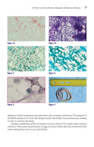 A Primer on the Laboratory Diagnosis of Infectious Diseases 7
sputum or related respiratory tract specimens, skin scrapings, and tissues. The purpose of
the KOH solution is to “clear” the background by “dissolving” tissue and bacteria, making
it easier to visualize the fungi.
Another modification of the wet mount is to mix a drop of 5% Lugol’s iodine solution
with feces. This stains any protozoans or eggs of various worms that may be present in the
stool, making them easier to see and identify.
Figure 1a Figure 1b
Figure 2 Figure 3
Figure 4 Figure 5
Gilligan_Primer_001-024.indd 7 7/24/14 11:42 AM
 