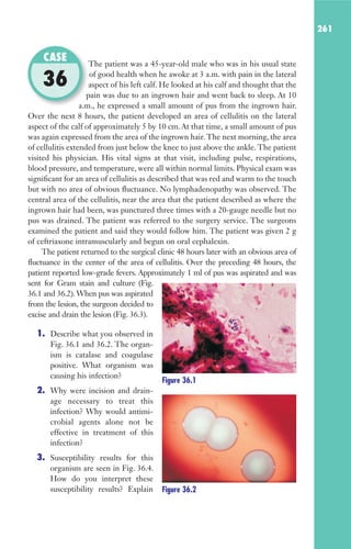 261
The patient was a 45-year-old male who was in his usual state
of good health when he awoke at 3 a.m. with pain in the lateral
aspect of his left calf. He looked at his calf and thought that the
pain was due to an ingrown hair and went back to sleep. At 10
a.m., he expressed a small amount of pus from the ingrown hair.
Over the next 8 hours, the patient developed an area of cellulitis on the lateral
aspect of the calf of approximately 5 by 10 cm. At that time, a small amount of pus
was again expressed from the area of the ingrown hair. The next morning, the area
of cellulitis extended from just below the knee to just above the ankle. The patient
visited his physician. His vital signs at that visit, including pulse, respirations,
blood pressure, and temperature, were all within normal limits. Physical exam was
significant for an area of cellulitis as described that was red and warm to the touch
but with no area of obvious fluctuance. No lymphadenopathy was observed. The
central area of the cellulitis, near the area that the patient described as where the
ingrown hair had been, was punctured three times with a 20-gauge needle but no
pus was drained. The patient was referred to the surgery service. The surgeons
examined the patient and said they would follow him. The patient was given 2 g
of ceftriaxone intramuscularly and begun on oral cephalexin.
The patient returned to the surgical clinic 48 hours later with an obvious area of
fluctuance in the center of the area of cellulitis. Over the preceding 48 hours, the
patient reported low-grade fevers. Approximately 1 ml of pus was aspirated and was
sent for Gram stain and culture (Fig.
36.1 and 36.2). When pus was aspirated
from the lesion, the surgeon decided to
excise and drain the lesion (Fig. 36.3).
1. Describe what you observed in
Fig. 36.1 and 36.2. The organ-
ism is catalase and coagulase
positive. What organism was
causing his infection?
2. Why were incision and drain-
age necessary to treat this
infection? Why would antimi-
crobial agents alone not be
effective in treatment of this
infection?
3. Susceptibility results for this
organism are seen in Fig. 36.4.
How do you interpret these
susceptibility results? Explain
The patient was a 45-year-old male who was in his usual state
aspect of his left calf. He looked at his calf and thought that the
pain was due to an ingrown hair and went back to sleep. At 10
a.m., he expressed a small amount of pus from the ingrown hair.
CASE
36
Figure 36.1
Figure 36.2
Gilligan_Sec4_255-306.indd 261 7/24/14 11:44 AM
 