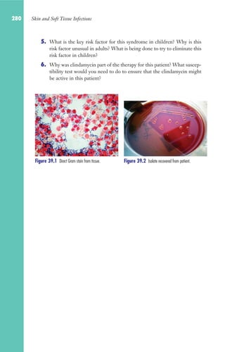280 Skin and Soft Tissue Infections
5. What is the key risk factor for this syndrome in children? Why is this
risk factor unusual in adults? What is being done to try to eliminate this
risk factor in children?
6. Why was clindamycin part of the therapy for this patient? What suscep-
tibility test would you need to do to ensure that the clindamycin might
be active in this patient?
Figure 39.2 Isolate recovered from patient.
Figure 39.1 Direct Gram stain from tissue.
Gilligan_Sec4_255-306.indd 280 7/24/14 11:44 AM
 