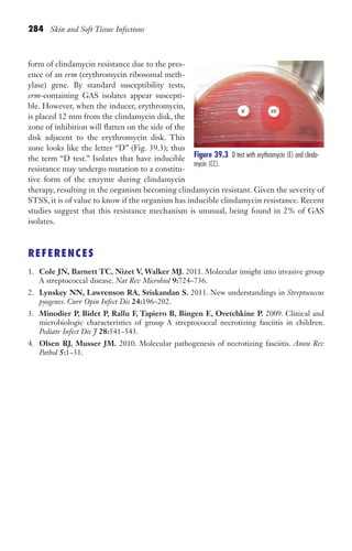 284 Skin and Soft Tissue Infections
form of clindamycin resistance due to the pres-
ence of an erm (erythromycin ribosomal meth-
ylase) gene. By standard susceptibility tests,
erm-containing GAS isolates appear suscepti-
ble. However, when the inducer, erythromycin,
is placed 12 mm from the clindamycin disk, the
zone of inhibition will flatten on the side of the
disk adjacent to the erythromycin disk. This
zone looks like the letter “D” (Fig. 39.3); thus
the term “D test.” Isolates that have inducible
resistance may undergo mutation to a constitu-
tive form of the enzyme during clindamycin
therapy, resulting in the organism becoming clindamycin resistant. Given the severity of
STSS, it is of value to know if the organism has inducible clindamycin resistance. Recent
studies suggest that this resistance mechanism is unusual, being found in 2% of GAS
isolates.
REFERENCES
1. Cole JN, Barnett TC, Nizet V, Walker MJ. 2011. Molecular insight into invasive group
A streptococcal disease. Nat Rev Microbiol 9:724–736.
2. Lynskey NN, Lawrenson RA, Sriskandan S. 2011. New understandings in Streptococcus
pyogenes. Curr Opin Infect Dis 24:196–202.
3. Minodier P, Bidet P, Rallu F, Tapiero B, Bingen E, Ovetchkine P. 2009. Clinical and
microbiologic characteristics of group A streptococcal necrotizing fasciitis in children.
Pediatr Infect Dis J 28:541–543.
4. Olsen RJ, Musser JM. 2010. Molecular pathogenesis of necrotizing fasciitis. Annu Rev
Pathol 5:1–31.
Figure 39.3 ​
D test with erythromycin (E) and clinda-
mycin (CC).
Gilligan_Sec4_255-306.indd 284 7/24/14 11:44 AM
 