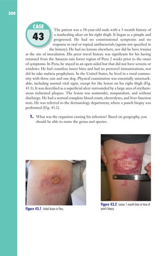 300
The patient was a 58-year-old male with a 3-month history of
a nonhealing ulcer on his right thigh. It began as a pimple and
progressed. He had no constitutional symptoms and no
response to oral or topical antibacterials (agents not specified in
the history). He had no lesions elsewhere, nor did he have trauma
at the site of inoculation. His prior travel history was significant for his having
returned from the Amazon rain forest region of Peru 2 weeks prior to the onset
of symptoms. In Peru, he stayed in an open-sided hut that did not have screens or
windows. He had countless insect bites and had no pretravel immunizations, nor
did he take malaria prophylaxis. In the United States, he lived in a rural commu-
nity with three cats and one dog. Physical examination was essentially unremark-
able, including normal vital signs, except for the lesion on his right thigh (Fig.
43.1). It was described as a superficial ulcer surrounded by a large area of erythem-
atous indurated plaques. The lesion was nontender, nonpurulent, and without
discharge. He had a normal complete blood count, electrolytes, and liver function
tests. He was referred to the dermatology department, where a punch biopsy was
performed (Fig. 43.2).
1. What was the organism causing his infection? Based on geography, you
should be able to name the genus and species.
The patient was a 58-year-old male with a 3-month history of
progressed. He had no constitutional symptoms and no
response to oral or topical antibacterials (agents not specified in
the history). He had no lesions elsewhere, nor did he have trauma
CASE
43
Figure 43.1 Initial lesion in Peru.
Figure 43.2 Lesion 1 month later at time of
punch biopsy.
Gilligan_Sec4_255-306.indd 300 7/24/14 11:44 AM
 
