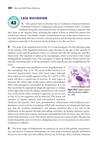 302 Skin and Soft Tissue Infections
CASE DISCUSSION
1. This patient had an infection due to Leishmania (Viannia) brasiliensis.
Leishmania Viannia is a subgroup of the genus Leishmania, with L. (Viannia)
brasiliensis being the most common cause of cutaneous disease in patients who
have been in the Amazon basin, including the region of Peru in which this patient had
traveled (see answer 3 for further details). Leishmaniasis is one of the most common rea-
sons that individuals who have traveled to South America and develop skin lesions consult
a physician, especially if the lesion is slowly healing, as was the case here.
2. The stage of the organism seen in Fig. 43.3 is a promastigote. It is the infectious stage
of the parasite. This flagellated protozoan stage develops in the gut of the sand fly. It
migrates to the sand fly proboscis, where it is injected into the skin during the sand fly’s
blood meal. The organism is taken up by macrophages, where it converts to the round,
nonflagellated amastigote form. The amastigote is taken up during a blood meal by the
sand fly, converting back to the promastigote in the sand fly gut and completing the life
cycle.
The amastigote form proliferates in the phagolysosome of
the macrophage (Fig. 43.4). The result of this infection is an
ulcerative papulonodular lesion with raised edges, although
these edges are not readily apparent in Fig. 43.1 and 43.2. The
lesion will have a central area of necrosis. In early stages of
infection, the raised edges of the lesion contain macrophages
filled with amastigotes, surrounded by lymphocytes. It is for
this reason that the appropriate diagnostic specimen is a biopsy
of the edge of the lesion. If a biopsy is performed in the central
area of the lesion, where crusting is apparent (as can be seen
in Fig. 43.2), few organisms will be observed. This lesion will
continue to expand outward until cell-mediated immunity
eliminates the parasite. Over time, granulomatous inflammation with lymphocyte pre-
dominance occurs and the macrophages filled with amastigotes are eliminated. Data sug-
gest that the cytokines interleukin-2 and gamma interferon play a key role in the
elimination of this parasite through macrophage activation. As healing continues, granu-
lation tissue forms that contains both giant and epitheloid cells. In most cases, the lesion
slowly heals and leaves a scar. This disease process occurs over many months. Because the
lesions frequently occur on the face, disfiguring scars are not uncommon in areas where
Leishmania is endemic.
3. The three stages of leishmaniasis are cutaneous (as seen in this patient), mucocutane-
ous, and visceral. Cutaneous leishmaniasis can cause both a localized, typically self-limited
disease (as seen in this case) and a diffuse, chronic one. In Europe,Africa, and Asia, cutaneous
brasiliensis
CASE
43
Figure 43.4 Organism grown on
culture from the biopsy (magnifica-
tion, ×400).
Gilligan_Sec4_255-306.indd 302 7/24/14 11:44 AM
 