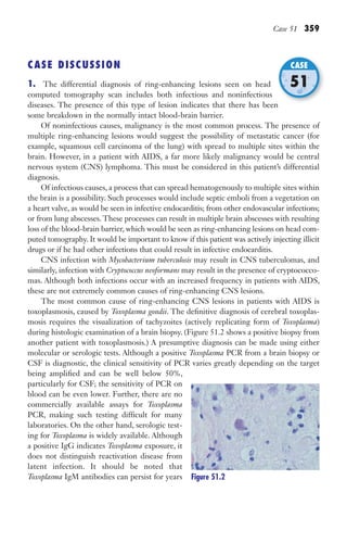 Case 51 359
CASE DISCUSSION
1. The differential diagnosis of ring-enhancing lesions seen on head
computed tomography scan includes both infectious and noninfectious
diseases. The presence of this type of lesion indicates that there has been
some breakdown in the normally intact blood-brain barrier.
Of noninfectious causes, malignancy is the most common process. The presence of
multiple ring-enhancing lesions would suggest the possibility of metastatic cancer (for
example, squamous cell carcinoma of the lung) with spread to multiple sites within the
brain. However, in a patient with AIDS, a far more likely malignancy would be central
nervous system (CNS) lymphoma. This must be considered in this patient’s differential
diagnosis.
Of infectious causes, a process that can spread hematogenously to multiple sites within
the brain is a possibility. Such processes would include septic emboli from a vegetation on
a heart valve, as would be seen in infective endocarditis; from other endovascular infections;
or from lung abscesses. These processes can result in multiple brain abscesses with resulting
loss of the blood-brain barrier, which would be seen as ring-enhancing lesions on head com-
puted tomography. It would be important to know if this patient was actively injecting illicit
drugs or if he had other infections that could result in infective endocarditis.
CNS infection with Mycobacterium tuberculosis may result in CNS tuberculomas, and
similarly, infection with Cryptococcus neoformans may result in the presence of cryptococco-
mas. Although both infections occur with an increased frequency in patients with AIDS,
these are not extremely common causes of ring-enhancing CNS lesions.
The most common cause of ring-enhancing CNS lesions in patients with AIDS is
toxoplasmosis, caused by Toxoplasma gondii. The definitive diagnosis of cerebral toxoplas-
mosis requires the visualization of tachyzoites (actively replicating form of Toxoplasma)
during histologic examination of a brain biopsy. (Figure 51.2 shows a positive biopsy from
another patient with toxoplasmosis.) A presumptive diagnosis can be made using either
molecular or serologic tests. Although a positive Toxoplasma PCR from a brain biopsy or
CSF is diagnostic, the clinical sensitivity of PCR varies greatly depending on the target
being amplified and can be well below 50%,
particularly for CSF; the sensitivity of PCR on
blood can be even lower. Further, there are no
commercially available assays for Toxoplasma
PCR, making such testing difficult for many
laboratories. On the other hand, serologic test-
ing for Toxoplasma is widely available. Although
a positive IgG indicates Toxoplasma exposure, it
does not distinguish reactivation disease from
latent infection. It should be noted that
Toxoplasma IgM antibodies can persist for years
diseases. The presence of this type of lesion indicates that there has been
CASE
51
Figure 51.2
Gilligan_Sec5_307-368.indd 359 7/24/14 11:46 AM
 