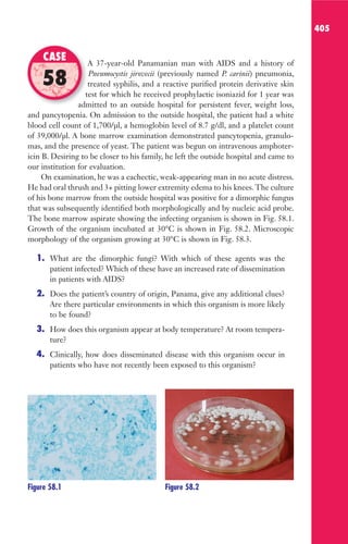 405
A 37-year-old Panamanian man with AIDS and a history of
Pneumocystis jirovecii (previously named P. carinii) pneumonia,
treated syphilis, and a reactive purified protein derivative skin
test for which he received prophylactic isoniazid for 1 year was
admitted to an outside hospital for persistent fever, weight loss,
and pancytopenia. On admission to the outside hospital, the patient had a white
blood cell count of 1,700/μl, a hemoglobin level of 8.7 g/dl, and a platelet count
of 39,000/μl. A bone marrow examination demonstrated pancytopenia, granulo-
mas, and the presence of yeast. The patient was begun on intravenous amphoter-
icin B. Desiring to be closer to his family, he left the outside hospital and came to
our institution for evaluation.
On examination, he was a cachectic, weak-appearing man in no acute distress.
He had oral thrush and 3+ pitting lower extremity edema to his knees.The culture
of his bone marrow from the outside hospital was positive for a dimorphic fungus
that was subsequently identified both morphologically and by nucleic acid probe.
The bone marrow aspirate showing the infecting organism is shown in Fig. 58.1.
Growth of the organism incubated at 30°C is shown in Fig. 58.2. Microscopic
morphology of the organism growing at 30°C is shown in Fig. 58.3.
1. What are the dimorphic fungi? With which of these agents was the
patient infected? Which of these have an increased rate of dissemination
in patients with AIDS?
2. Does the patient’s country of origin, Panama, give any additional clues?
Are there particular environments in which this organism is more likely
to be found?
3. How does this organism appear at body temperature? At room tempera-
ture?
4. Clinically, how does disseminated disease with this organism occur in
patients who have not recently been exposed to this organism?
A 37-year-old Panamanian man with AIDS and a history of
treated syphilis, and a reactive purified protein derivative skin
test for which he received prophylactic isoniazid for 1 year was
admitted to an outside hospital for persistent fever, weight loss,
CASE
58
Figure 58.1 Figure 58.2
Gilligan_Sec6_369-436.indd 405 7/24/14 11:14 AM
 