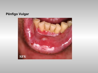 Pênfigo Vulgar 