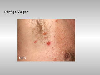 Pênfigo Vulgar 