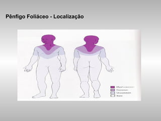 Pênfigo Foliáceo  - Localização 