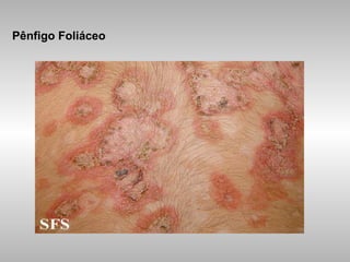 Pênfigo Foliáceo 