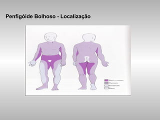 Penfigóide Bolhoso - Localização 