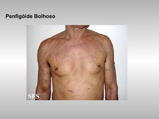 Penfigóide Bolhoso 
