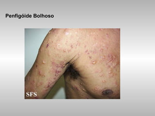 Penfigóide Bolhoso 