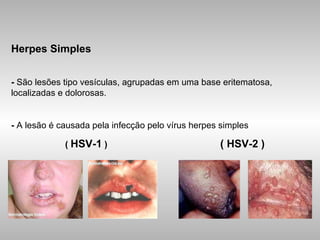Herpes Simples -  São lesões tipo vesículas, agrupadas em uma base eritematosa, localizadas e dolorosas. -  A lesão é causada pela infecção pelo vírus herpes simples (  HSV-1  )  ( HSV-2 ) 