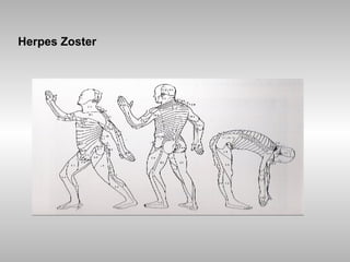 Herpes Zoster 