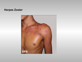 Herpes Zoster 