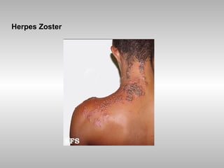 Herpes Zoster 