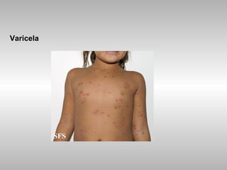 Varicela 