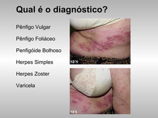Qual é o diagnóstico? Pênfigo Vulgar Pênfigo Foliáceo Penfigóide Bolhoso Herpes Simples Herpes Zoster Varicela 